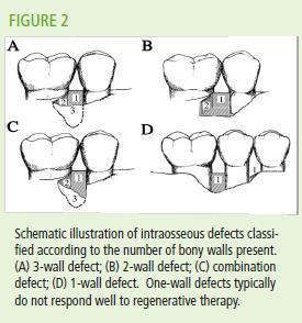 Periodontal Defects And Regenerative Success